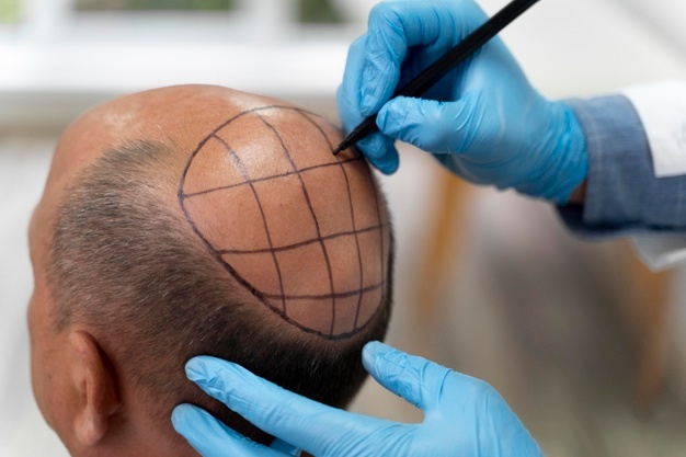 Differences Between FUE Hair Transplant and FUT