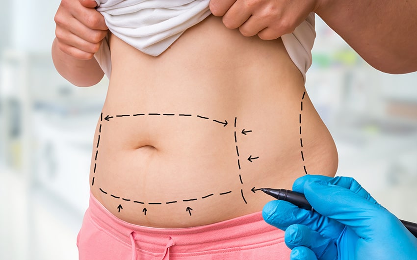 Liposuction