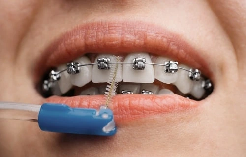 How is braces treatment performed